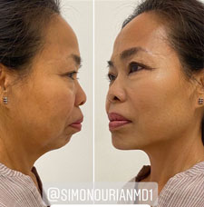 Non surgical facelift image2