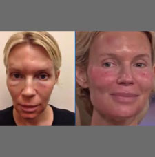 Non surgical facelift image21