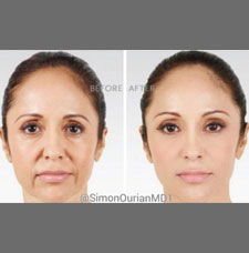 Non surgical facelift image22