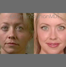 Non surgical facelift image23