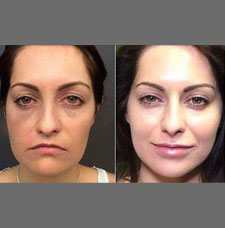 Non surgical facelift image24