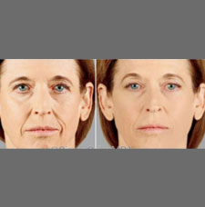 Non surgical facelift image25