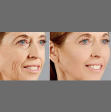 Non surgical facelift image26