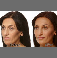 Non surgical facelift image27