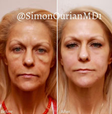 Non surgical facelift image4