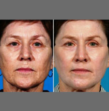 Non surgical facelift image6