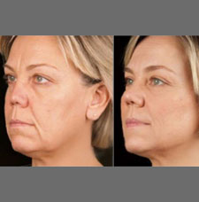 Non surgical facelift image7