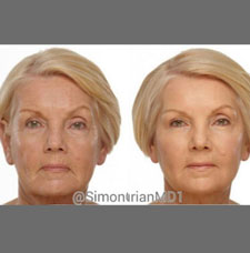 Non surgical facelift image8