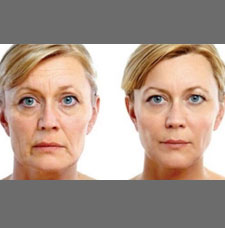 Non surgical facelift image9