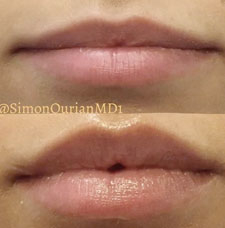 Non surgical lip augmentation image1