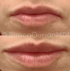 Non surgical lip augmentation image10