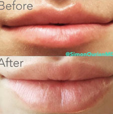 Non surgical lip augmentation image11