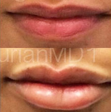 Non surgical lip augmentation image12