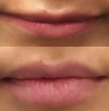 Non surgical lip augmentation image13