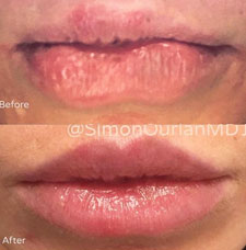 Non surgical lip augmentation image14