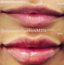 Non surgical lip augmentation image15