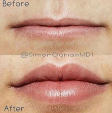 Non surgical lip augmentation image16