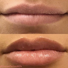 Non surgical lip augmentation image17