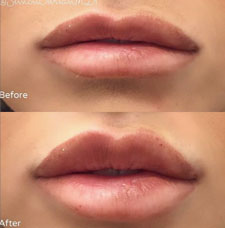 Non surgical lip augmentation image18