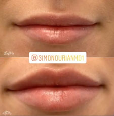 Non surgical lip augmentation image19