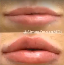 Non surgical lip augmentation image2