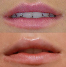 Non surgical lip augmentation image20