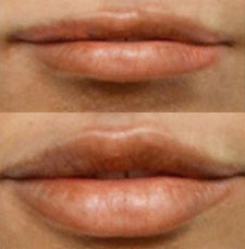 Non surgical lip augmentation image3