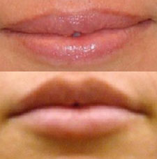Non surgical lip augmentation image4