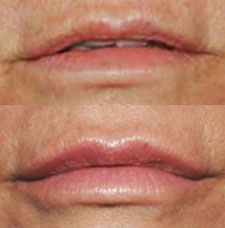 Non surgical lip augmentation image5