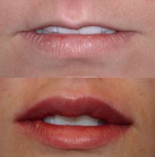 Non surgical lip augmentation image6