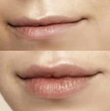 Non surgical lip augmentation image7