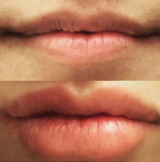 Non surgical lip augmentation image8