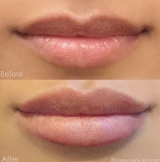 Non surgical lip augmentation image9