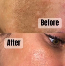 skin resurfacing image1