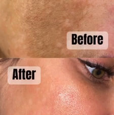 skin resurfacing image1