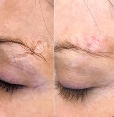 skin resurfacing image4