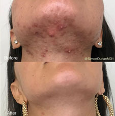 skin resurfacing image5