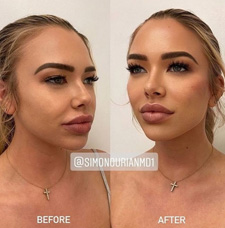 Cheek Contouring before and after patient image1