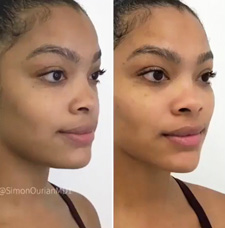 Cheek Contouring before and after patient image10