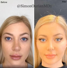 Cheek Contouring before and after patient image11