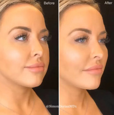Cheek Contouring before and after patient image2