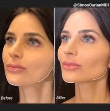 Cheek Contouring before and after patient image3