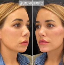 Cheek Contouring before and after patient image5