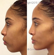 Cheek Contouring before and after patient image6