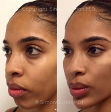 Cheek Contouring before and after patient image7