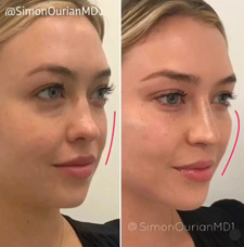 Cheek Contouring before and after patient image8