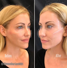 Cheek Contouring before and after patient image9