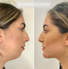 Facial Contouring before and after patient image1