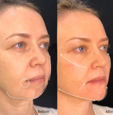 Facial Contouring before and after patient image3