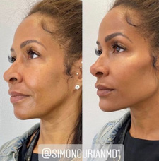 Facial Contouring before and after patient image4